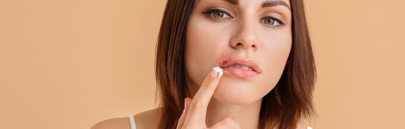 A woman putting a topical cream on a sold sore on her lip.